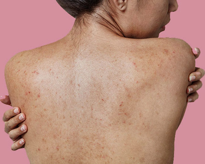 Điều Trị Mụn Lưng Tại Sen Beauty